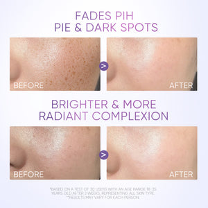 5PCS! Anti Dark Spot Set