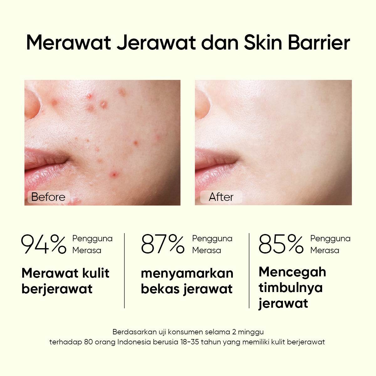 Salicylic Acid Anti Acne Serum