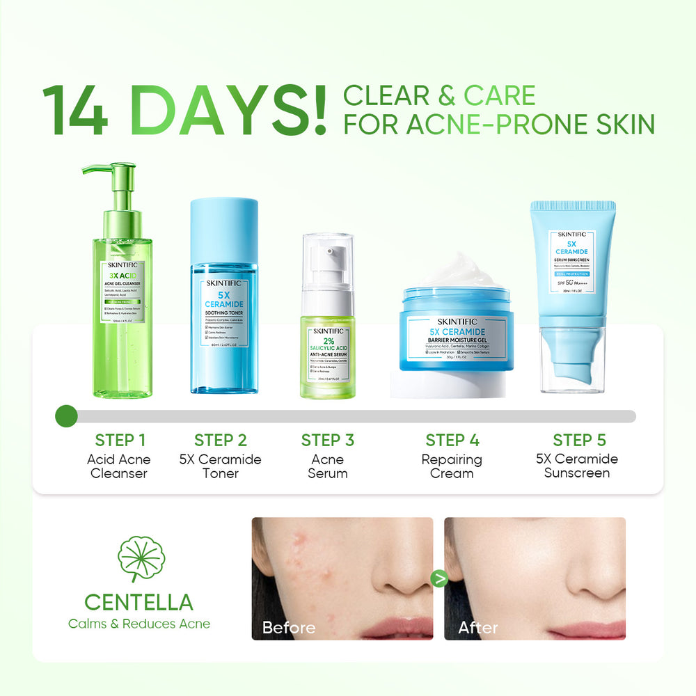 5PCS! Anti Acne Set